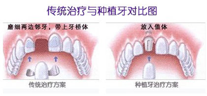 镶牙好还是种牙好