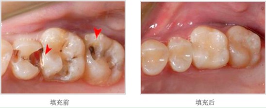 蛀牙补牙效果