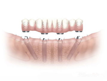 全口种植牙要多少钱
